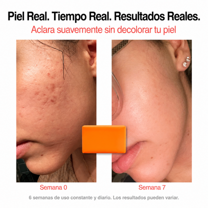 Barra Anti Acné Fórmula con Vitamina C, Alfa-Arbutina y Cúrcuma