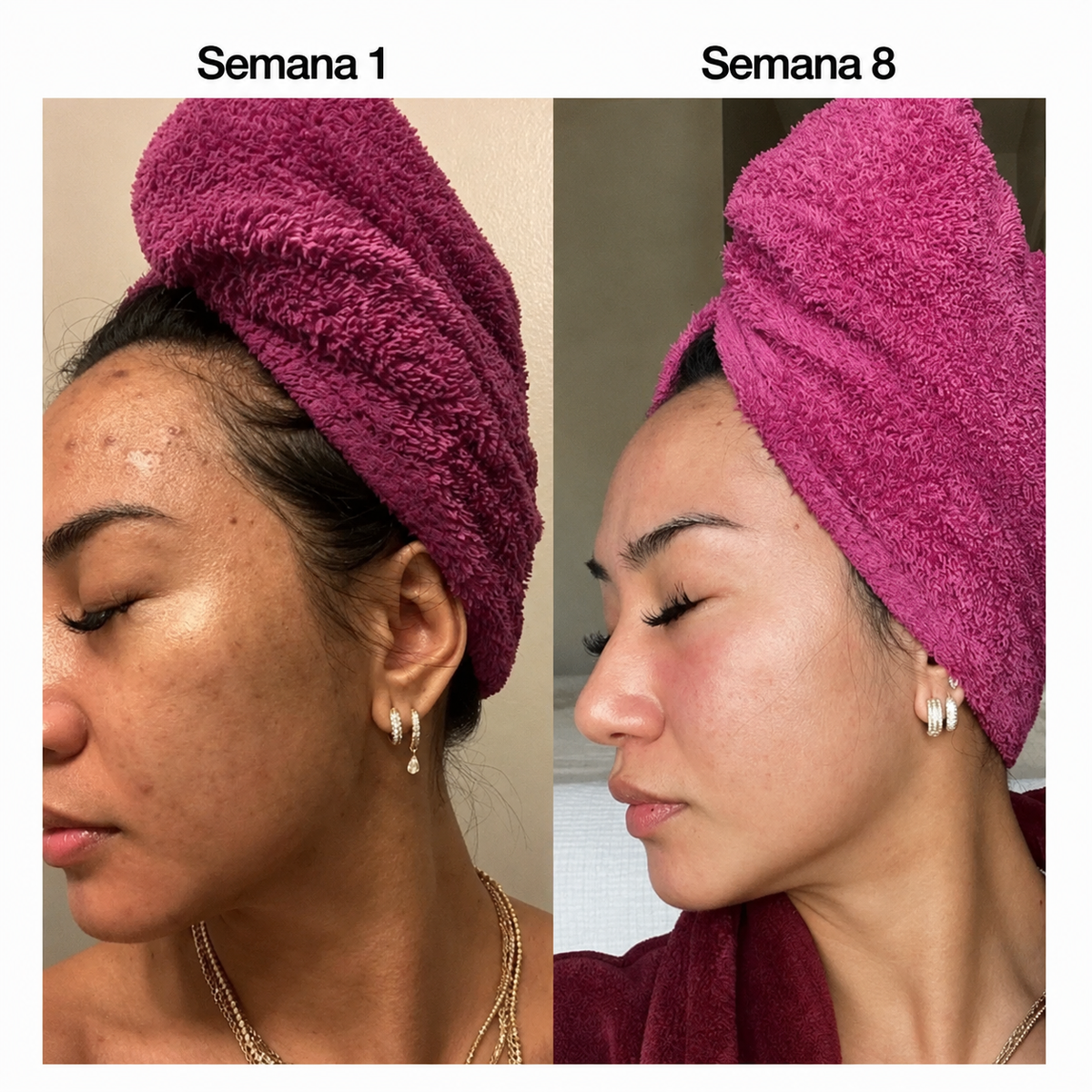 Barra Anti Acné Fórmula con Vitamina C, Alfa-Arbutina y Cúrcuma